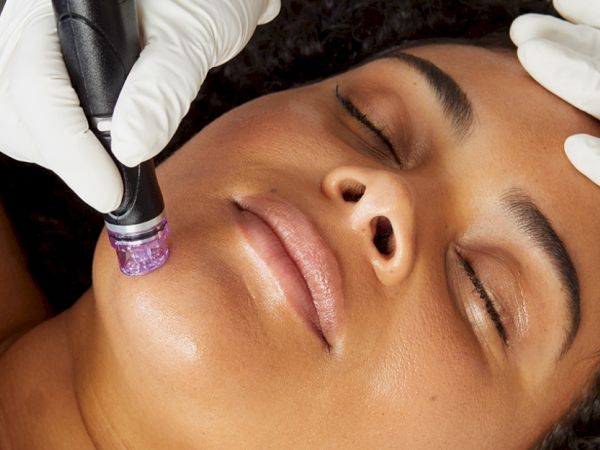 Close-up of a woman getting a facial treatment as a clinician&rsquo;s gloved hand uses a micro-needle device on her skin.